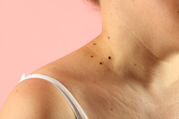 Woman with moles on her skin against pink background, closeup