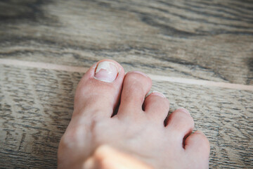 Closeup of foot with peeling and damaged toenail on big toe over wooden floor, concept of personal care and nail health
