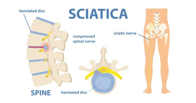 Sciatic nerve pain in lower back. Moving banner with educational medical infographics with spine and herniated disc compressing nerve. Pain and illness. Flat graphic animated cartoon