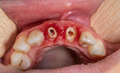 Occlusal view of decayed central incisal tooth with remaining roots in the bloody gingiva gum,...