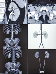 CT scan of KUB with contrast : Left renal small partially exophytic cortical cyst is seen at lower...