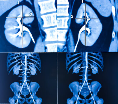 CT scan of KUB with contrast : Left renal small partially exophytic cortical cyst is seen at lower pole. Kidney cyst. Bilateral renal cortical simple cysts.