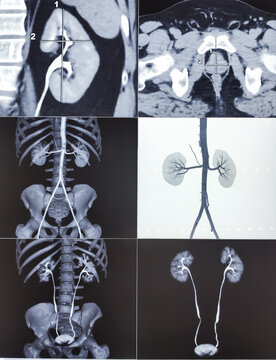 CT scan of KUB with contrast : Left renal small partially exophytic cortical cyst is seen at lower pole. Kidney cyst. Bilateral renal cortical simple cysts.