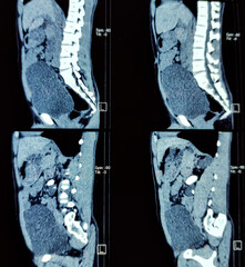CT scan of KUB (non-contrast): Large calculus at left pelvi-ureteric junction(PUJ) with left sided...