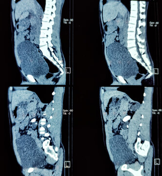 CT scan of KUB (non-contrast): Large calculus at left pelvi-ureteric junction(PUJ) with left sided gross hydro-ureteronephrosis. Kidney stone.