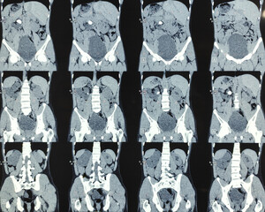 CT scan of KUB (non-contrast): Large calculus at left pelvi-ureteric junction(PUJ) with left sided...