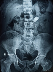Digital X-Ray of KUB : Large calculus at left pelvi-ureteric junction(PUJ) with left sided gross hydro-ureteronephrosis. Kidney stone.