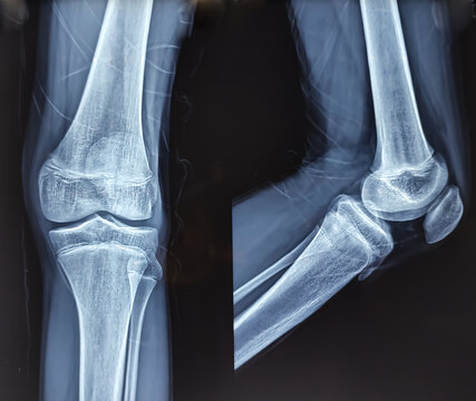 Knee joint x-ray ap and lateral view, Early degenerative osteoarthritis.