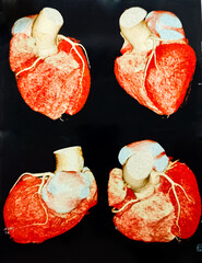 Computer tomography angiography CTA of coronary artery. The study use for diagnosis the heart vessel problem that made the patient suffer from myocardial infractions or acute coronary syndrome.