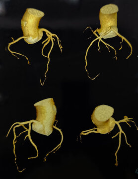 Computer tomography angiography CTA of coronary artery. The study use for diagnosis the heart vessel problem that made the patient suffer from myocardial infractions or acute coronary syndrome.