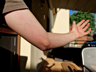 The child is stung by a wasp. He has a blister and is at risk of anaphylactic shock. Give antihistamines in time. Hand with a red sore