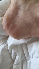 allergic reaction after being stung by an insect in the heel of the foot