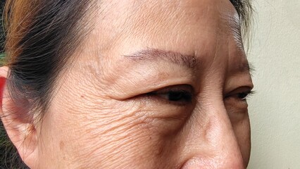 close up of a woman looking up, Flabby skin and creases, swelling and ptosis beside her eye, dark...