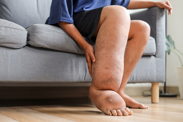 Person Sitting On Sofa With One Leg Severely Swollen Due To Lymphatic Filariasis