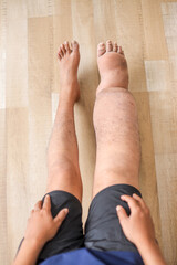 Top View Of Person's Legs One Significantly Swollen From Elephantiasis