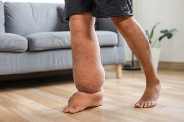 Close Up Of Elephantiasis Affecting Lower Limb With The Other Leg Appearing Normal