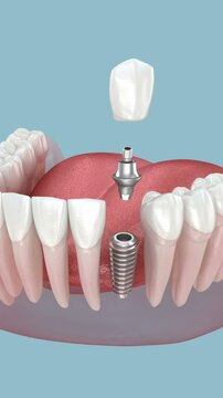 Dental implant and ceramic crown. Medically accurate tooth 3D Animation