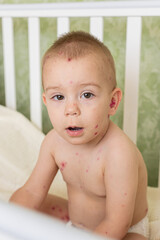 Toddler with Chickenpox Sitting in Bed