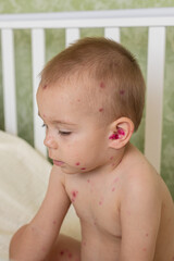 Toddler with Chickenpox Sitting in Bed