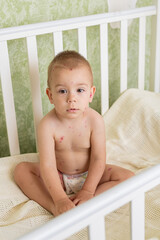 Toddler with Chickenpox Sitting in Bed