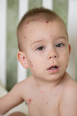 Toddler with Chickenpox Sitting in Bed