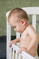 Toddler with Chickenpox Sitting in Bed