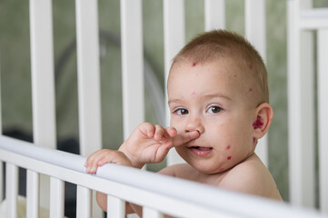 Toddler with Chickenpox Sitting in Bed