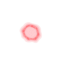 Dermatophytosis illustration