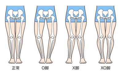 正常な脚、O脚、X脚、XO脚の姿勢と骨格