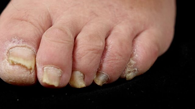 close-up of toenail infection ringworm in human on black background