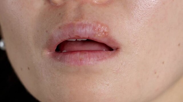 Herpes on the lips of the young woman