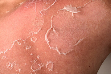 Close-Up of Peeling Sunburned Skin on Shoulder Showing Damage and Natural Healing Process