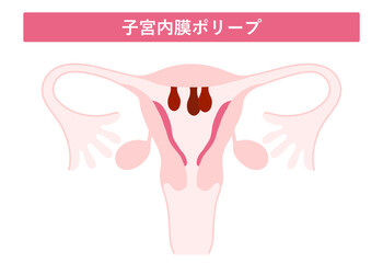子宮内膜ポリープ