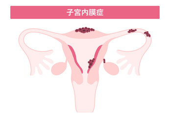 子宮内膜症