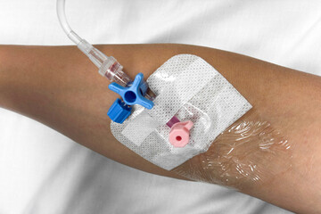 Close up view of a patient’s arm with a pink intravenous (IV) cannula and blue three way stopcock valve inserted for hospital treatment, fluid therapy, or medication administration in a clinical setti