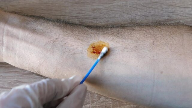 Iodine patch test. Testing iodine deficiency