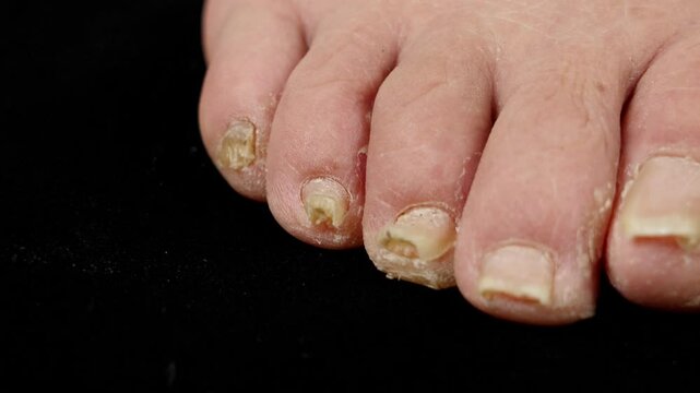 close-up of toenail infection ringworm in human on black background