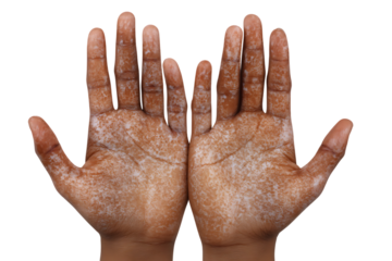 Close up of hands with visible signs of skin condition.
