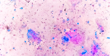 Mycobacterium tuberculosis positive (small red rod) in sputum smear, acid-fast stain, analyze by microscope 40x