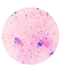 Mycobacterium tuberculosis positive (small red rod) in sputum smear, acid-fast stain, analyze by microscope 40x