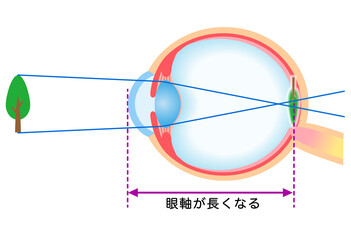 目の構造　軸性近視　視力