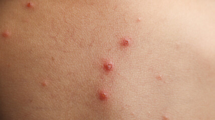 Fototapeta premium red spots on a child's skin due to chicken pox or the varicella virus