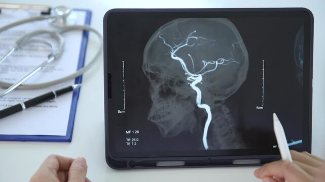 Neurologist or Neurosurgeon Doctor diagnose cerebral blood vessel x-ray image on digital tablet for diagnose stroke brain disease.