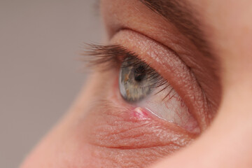 Inflammation of the eye with barley (Hordeolum) on the lower eyelid in a man. Ophthalmologist...