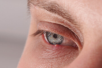 Ocular inflammation of barley (Hordeolum) on the lower eyelid in a man.