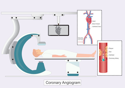 A coronary angiogram CAG is a test that uses X rays and contrast dye