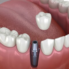 Dental Implant Placement Procedure Showing Implant Post Crown and Gum Tissue in a Human Mouth for Dental Health Education