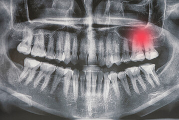 X-ray of the jaw, toothache, caries, pulpitis, gum inflammation