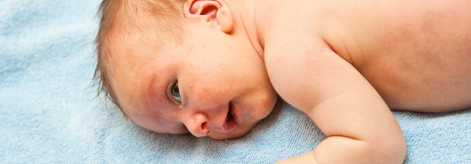 newborn baby lying down. jaundice pimples on skin. close-up portrait