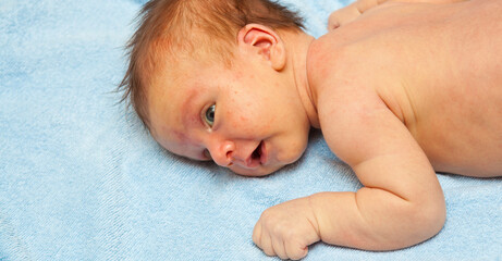 newborn baby lying down. jaundice pimples on skin. close-up portrait